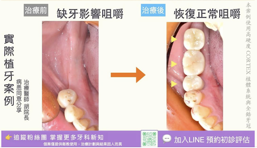 案例分享58｜我想要門牙看起來整體性好看該怎麼辦？