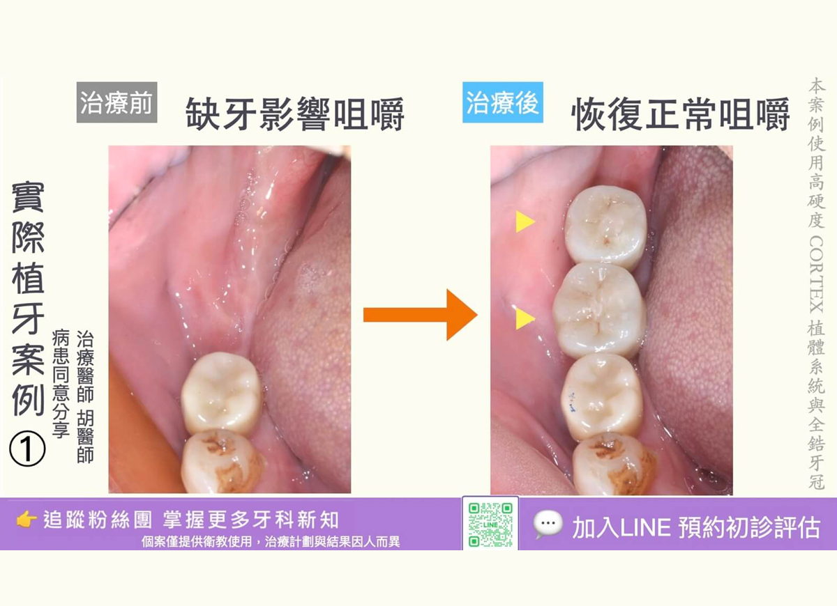 人工植牙治療實際案例成果/ 京品牙科胡醫師