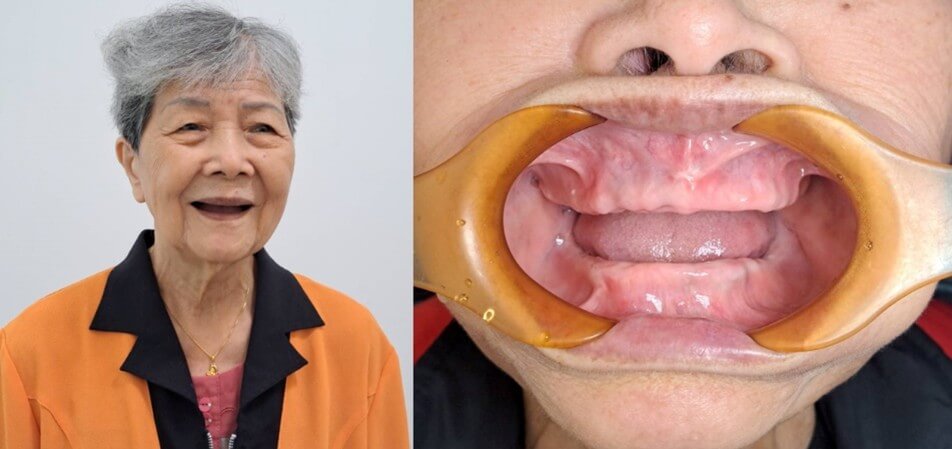 戴阿姨缺牙前照片