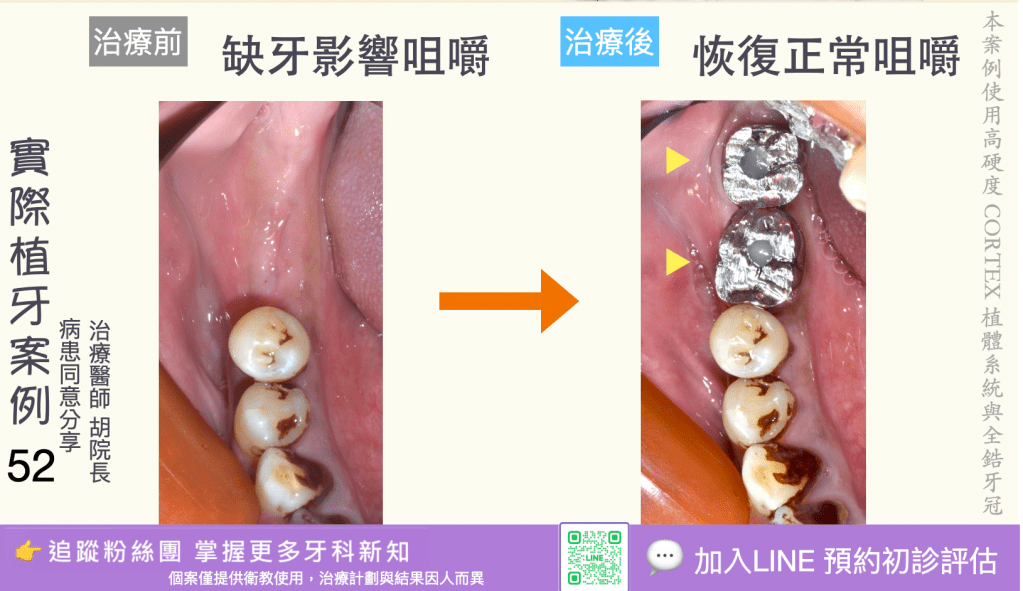 人工植牙治療實際案例成果50