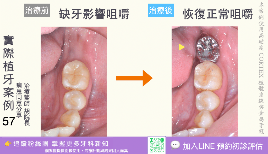 人工植牙治療實際案例成果55