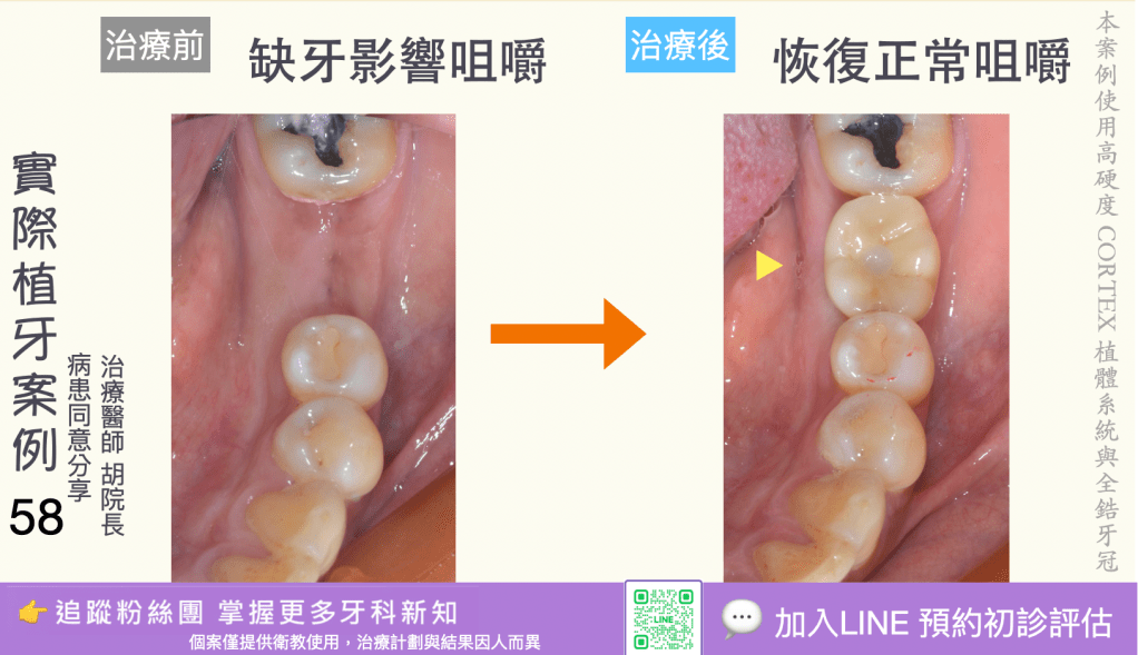 人工植牙治療實際案例成果56