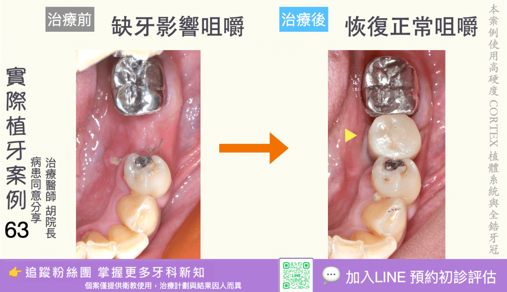 人工植牙治療實際案例成果61