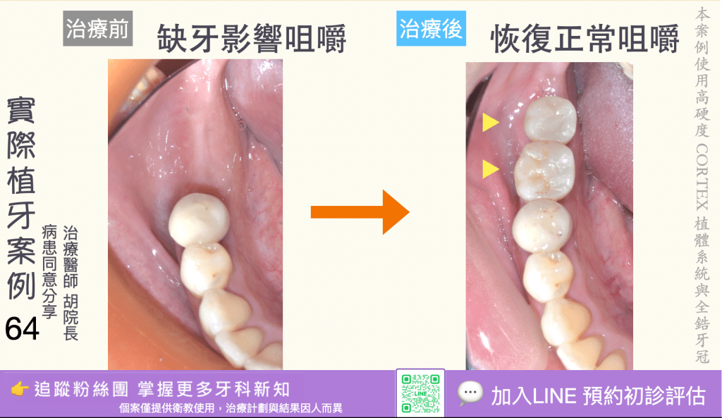 人工植牙治療實際案例成果62