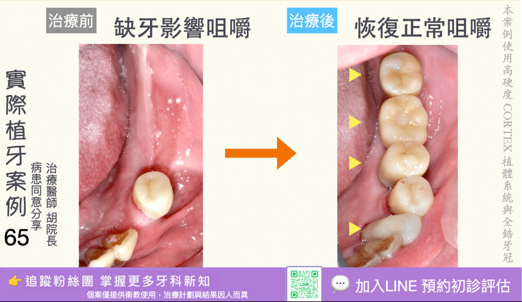 人工植牙治療實際案例成果63