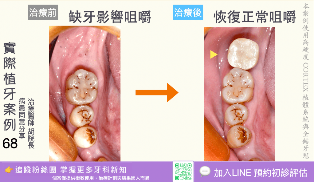 人工植牙治療實際案例成果66