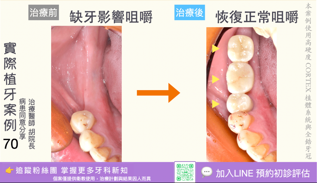 人工植牙治療實際案例成果68