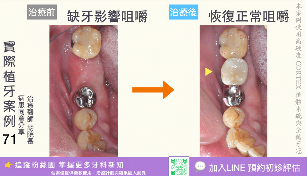 人工植牙治療實際案例成果69