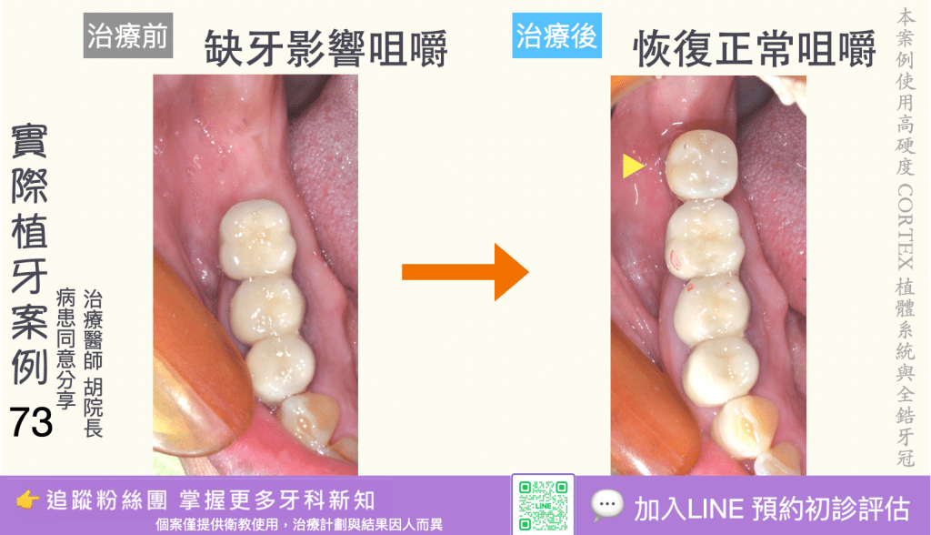 人工植牙治療實際案例成果71