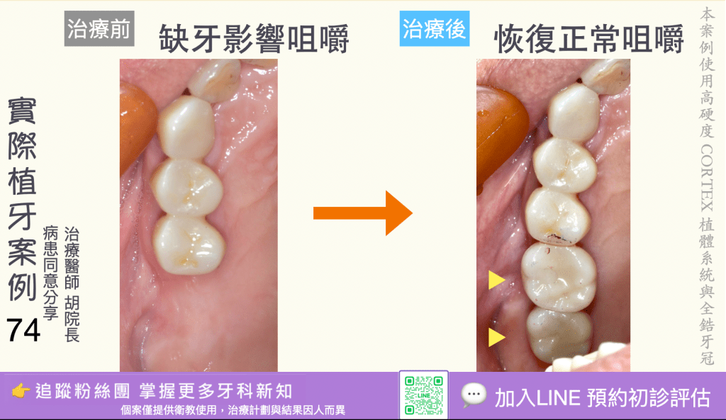 人工植牙治療實際案例成果72
