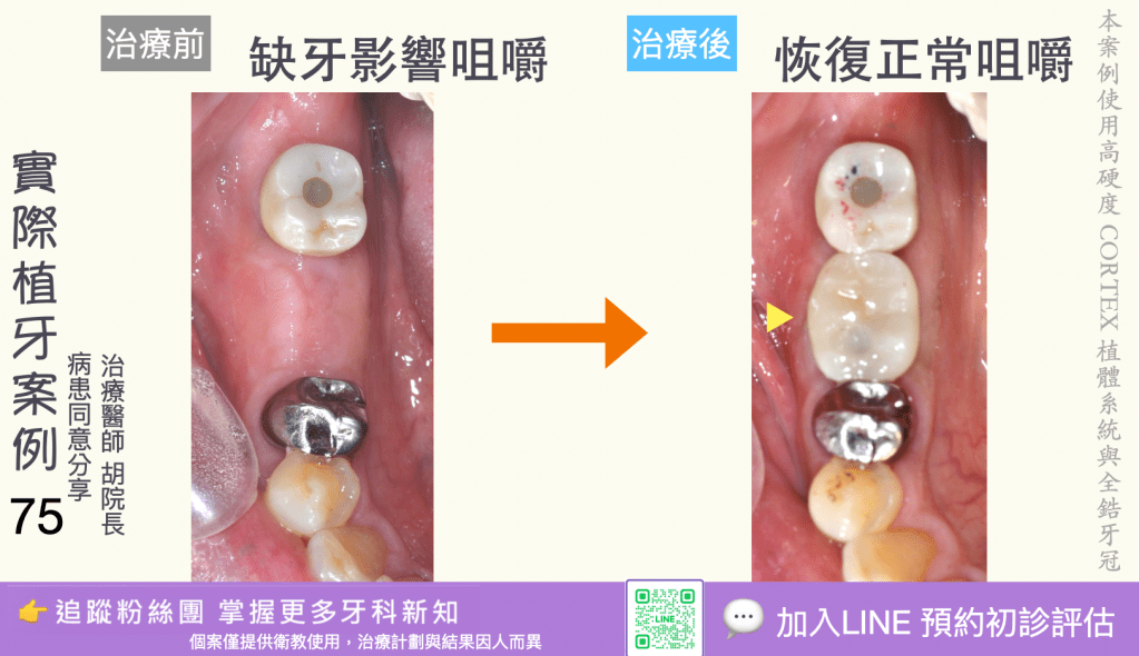 人工植牙治療實際案例成果73