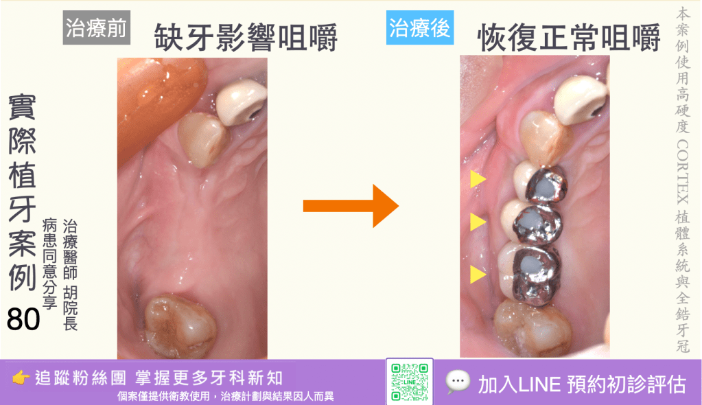人工植牙治療實際案例成果78