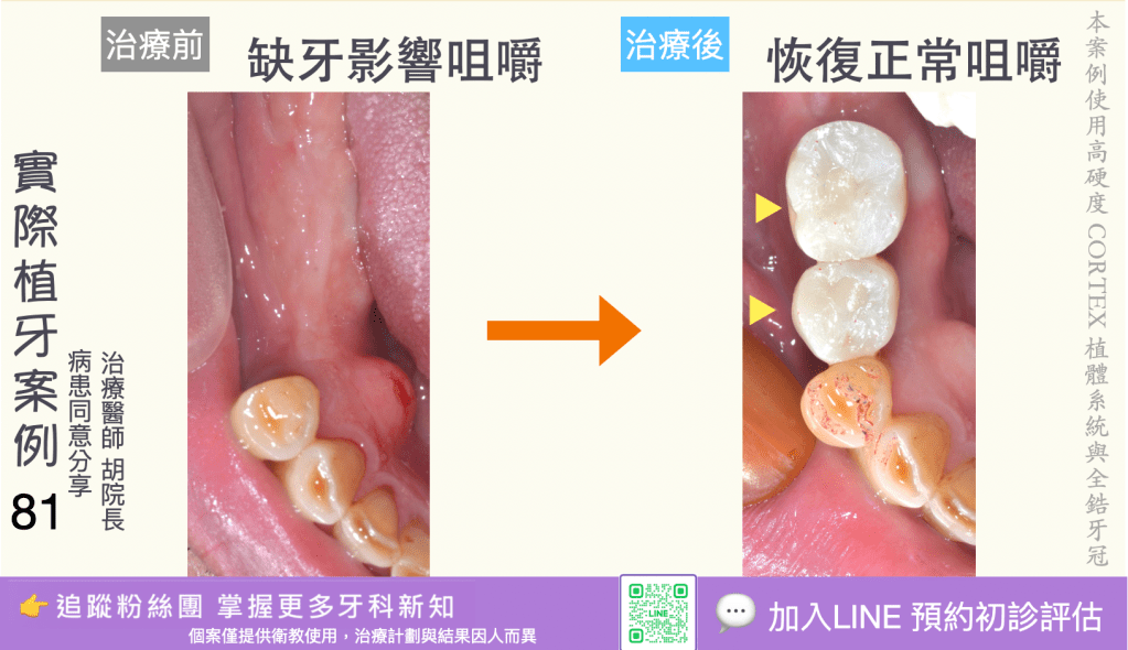 人工植牙治療實際案例成果79