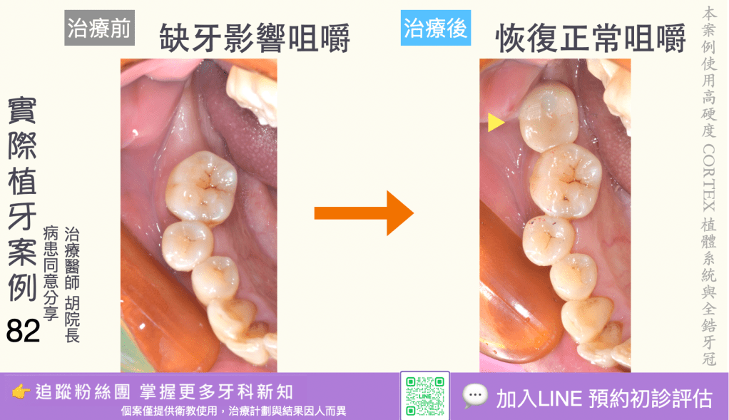 人工植牙治療實際案例成果80