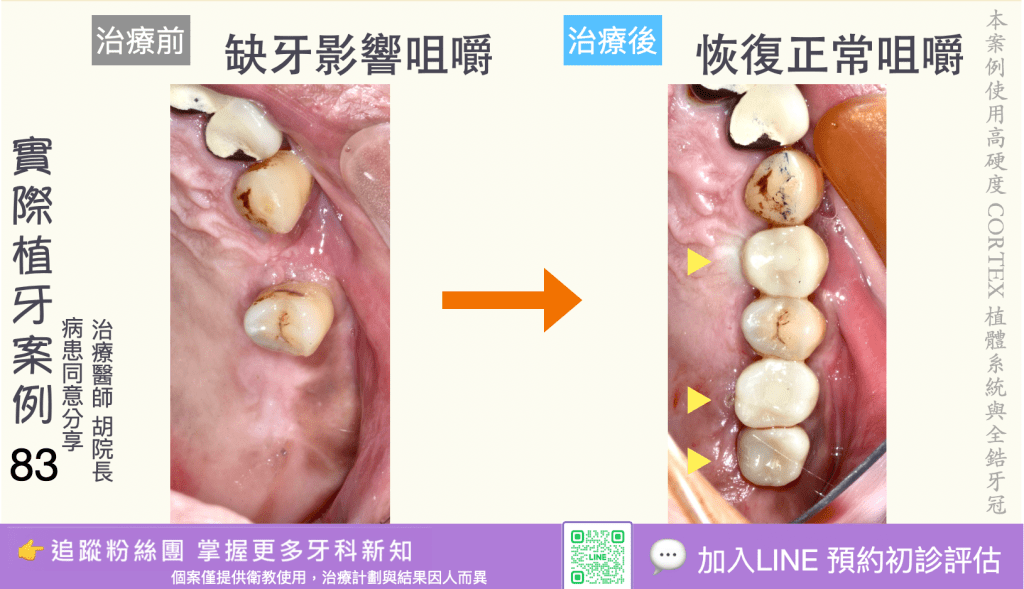 人工植牙治療實際案例成果81