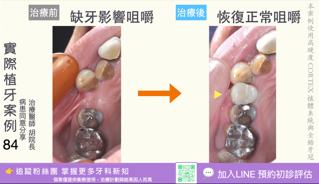 人工植牙治療實際案例成果82
