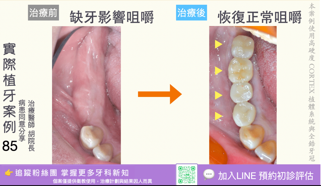 人工植牙治療實際案例成果83