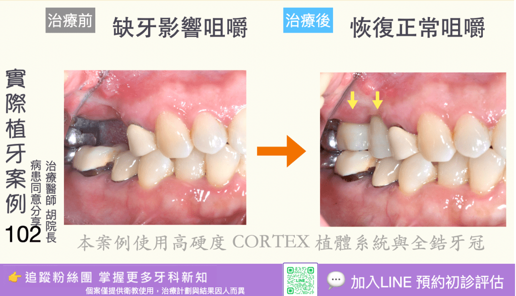 人工植牙治療實際案例成果100