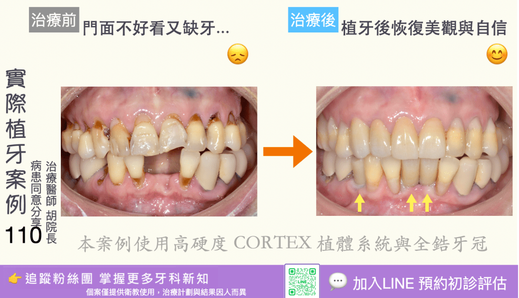 人工植牙治療實際案例成果108