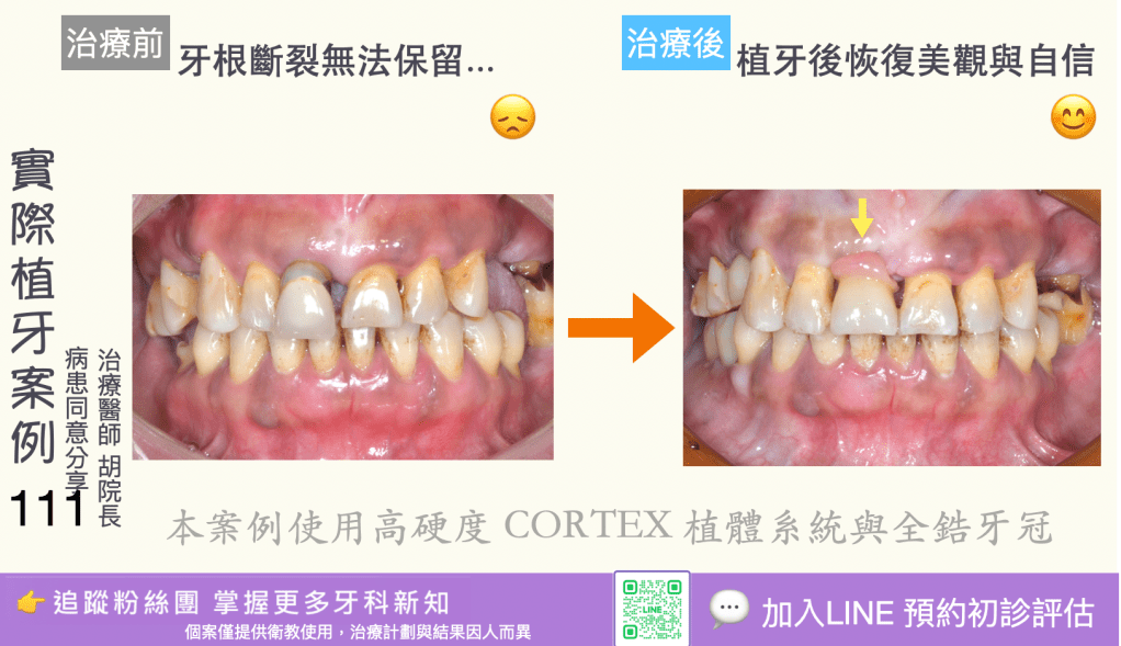 人工植牙治療實際案例成果109