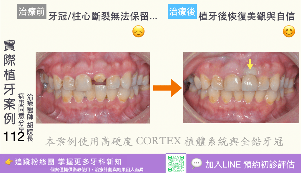 人工植牙治療實際案例成果110