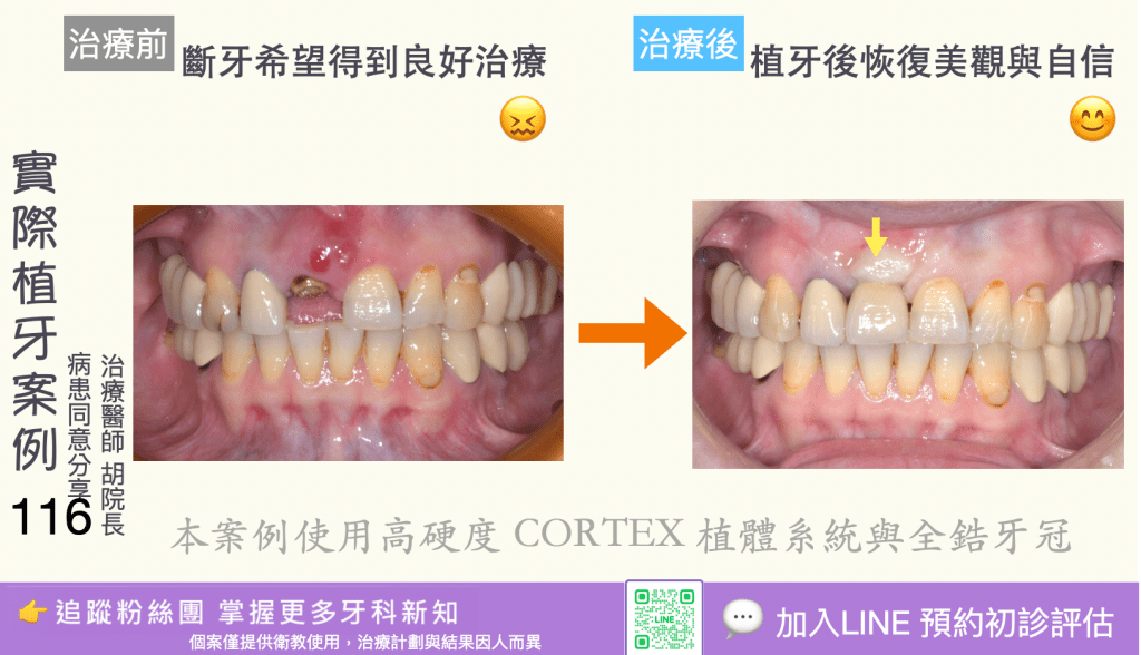 人工植牙治療實際案例成果114
