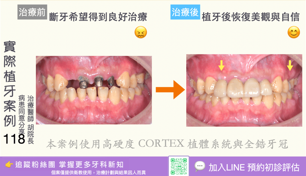 人工植牙治療實際案例成果116