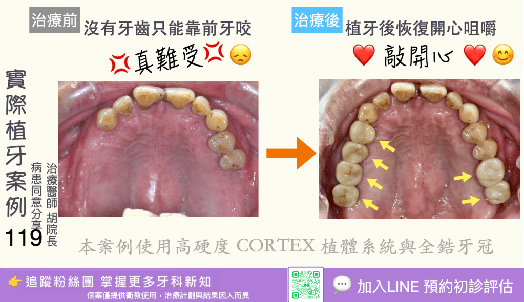人工植牙治療實際案例成果117