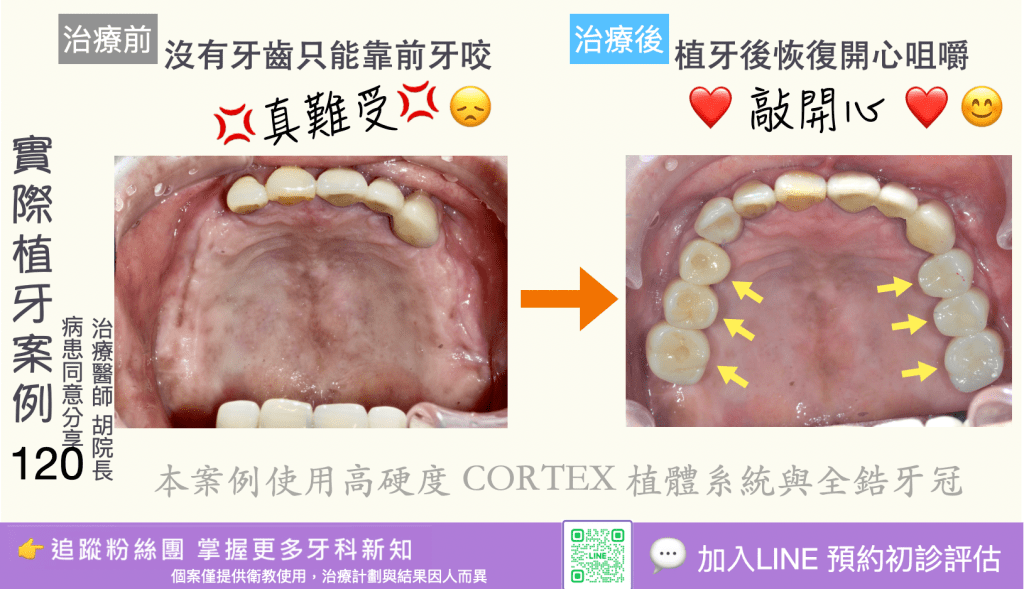人工植牙治療實際案例成果118