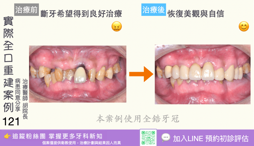 人工植牙治療實際案例成果119