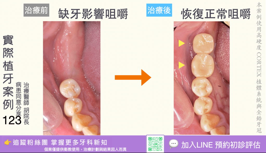 人工植牙治療實際案例成果121