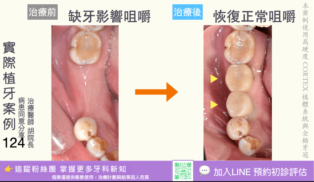 人工植牙治療實際案例成果122