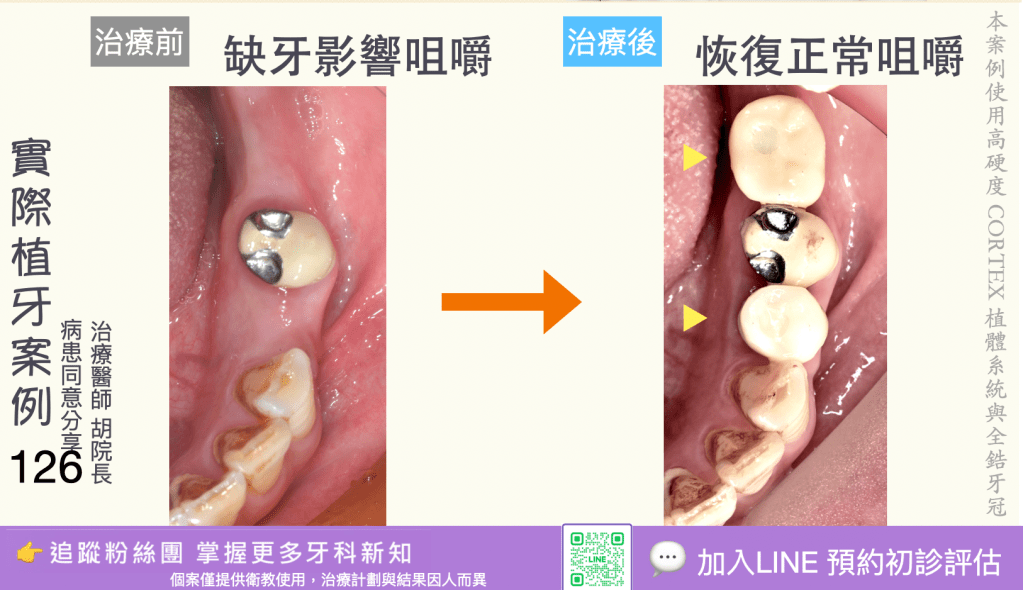 人工植牙治療實際案例成果124