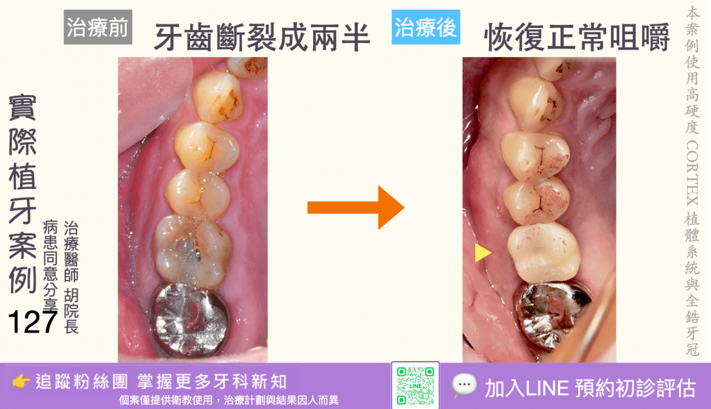 人工植牙治療實際案例成果125