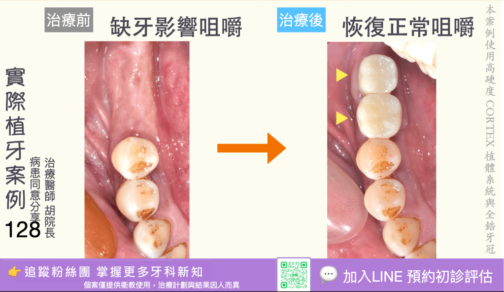 人工植牙治療實際案例成果126