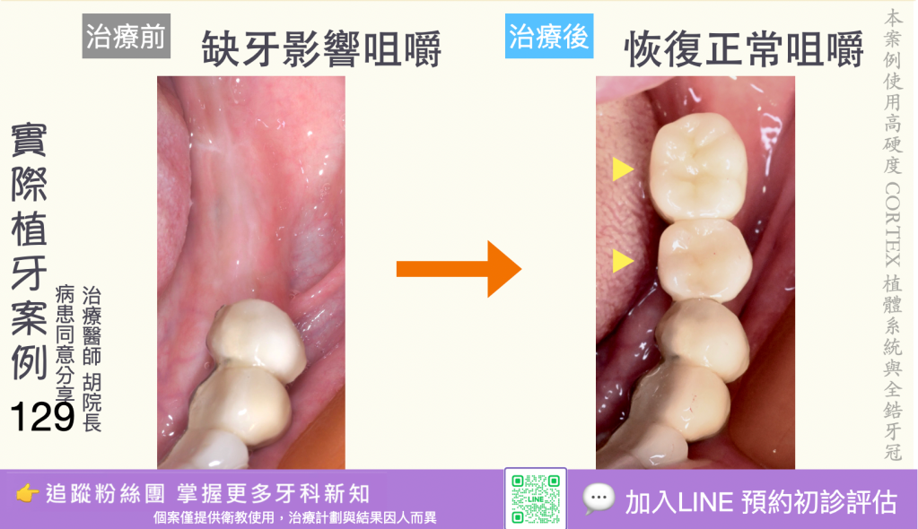 人工植牙治療實際案例成果127