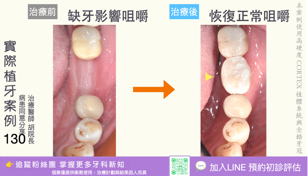 人工植牙治療實際案例成果128