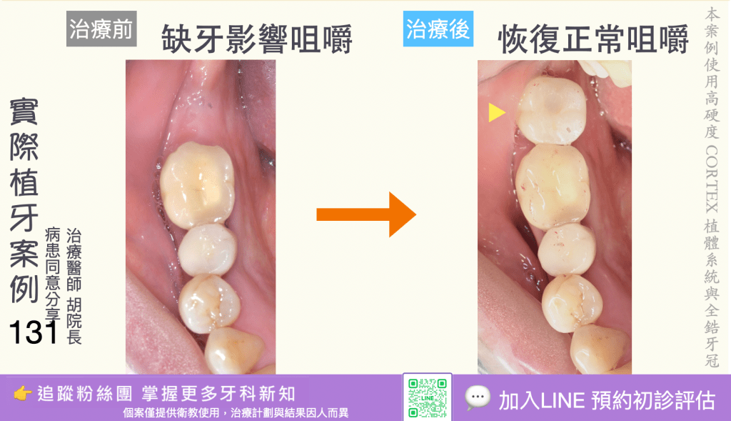 人工植牙治療實際案例成果129
