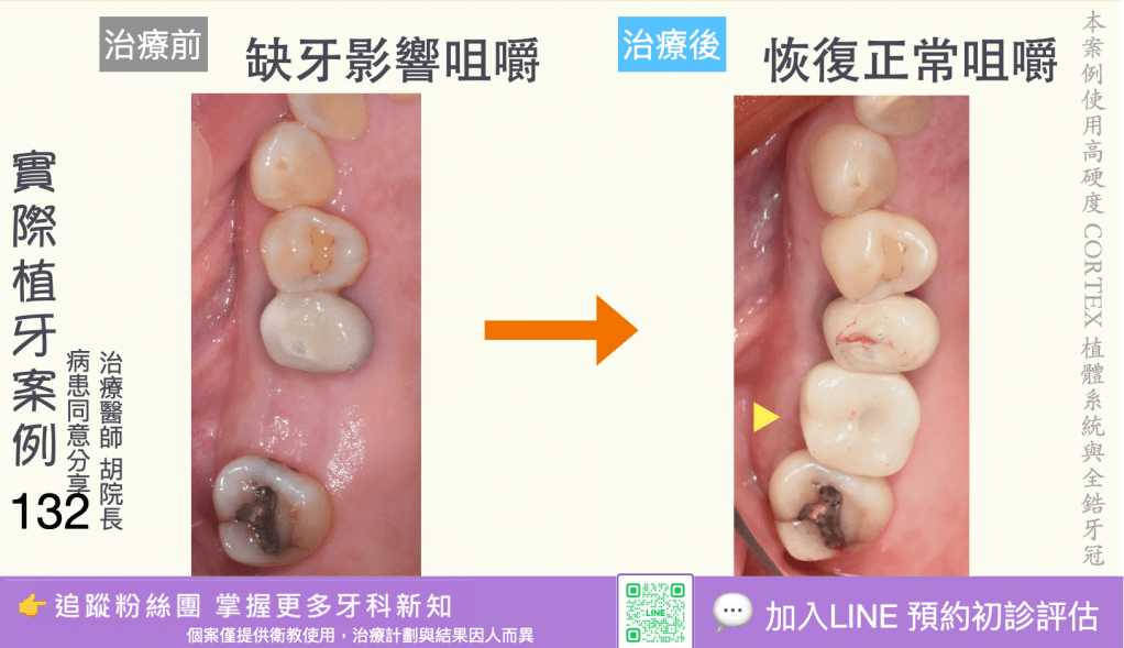 人工植牙治療實際案例成果130