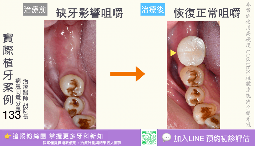 人工植牙治療實際案例成果131