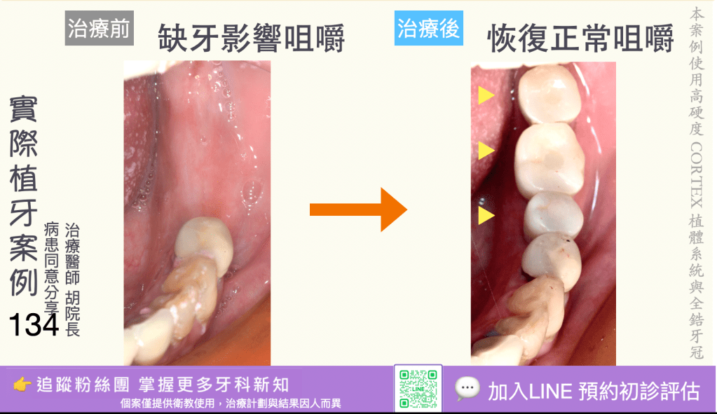 人工植牙治療實際案例成果132