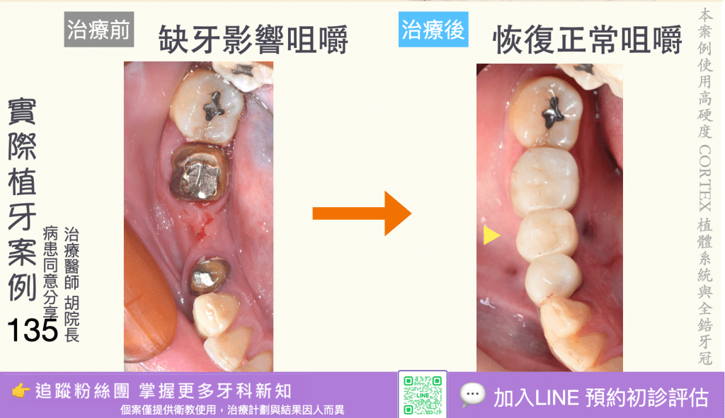 人工植牙治療實際案例成果133
