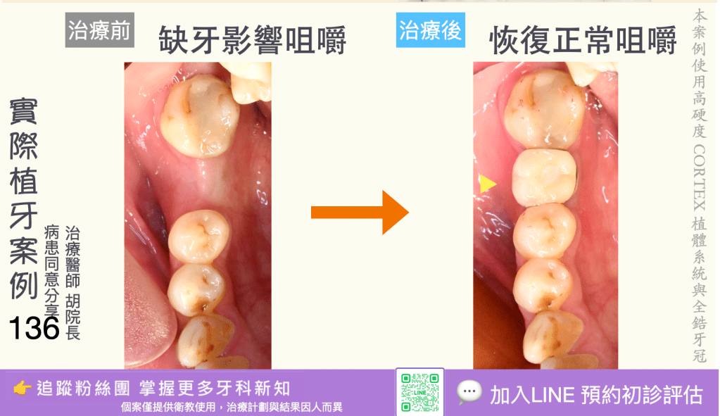 人工植牙治療實際案例成果134