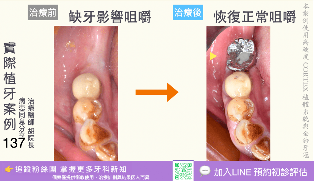 人工植牙治療實際案例成果135