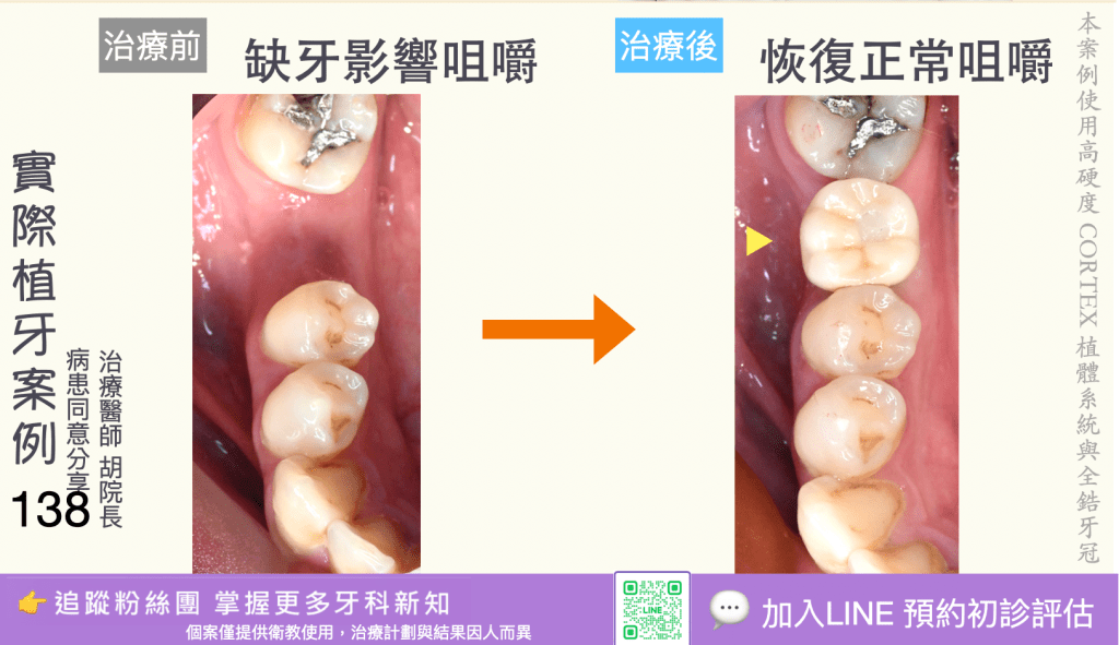 人工植牙治療實際案例成果136