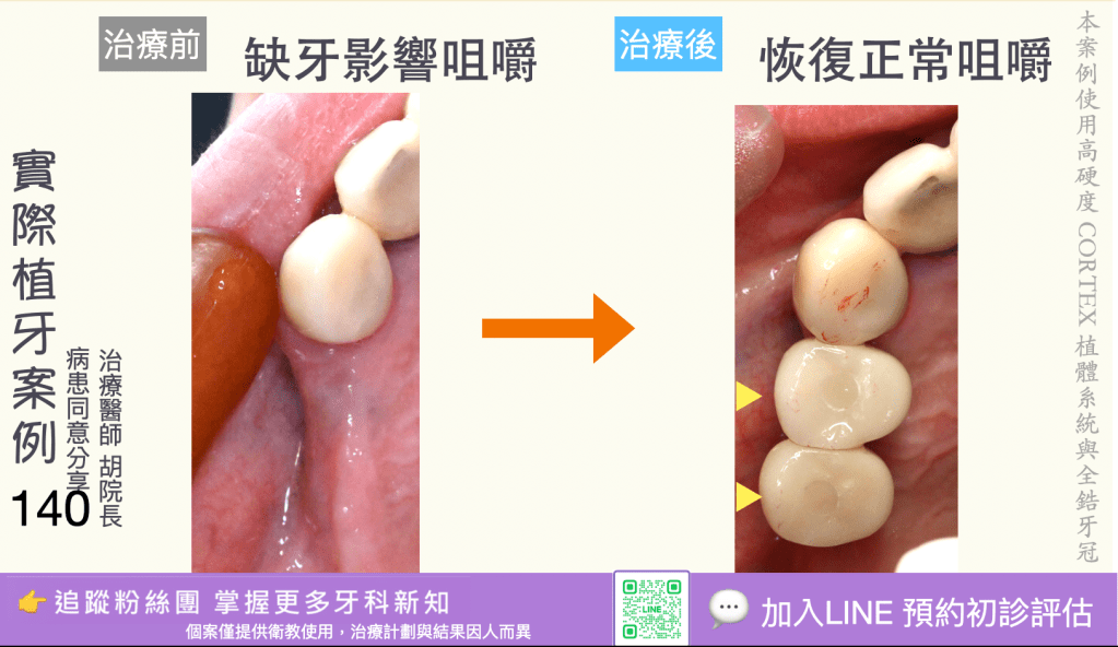 人工植牙治療實際案例成果138