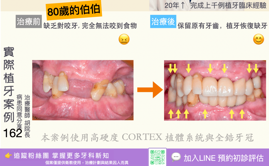 人工植牙治療實際案例成果160