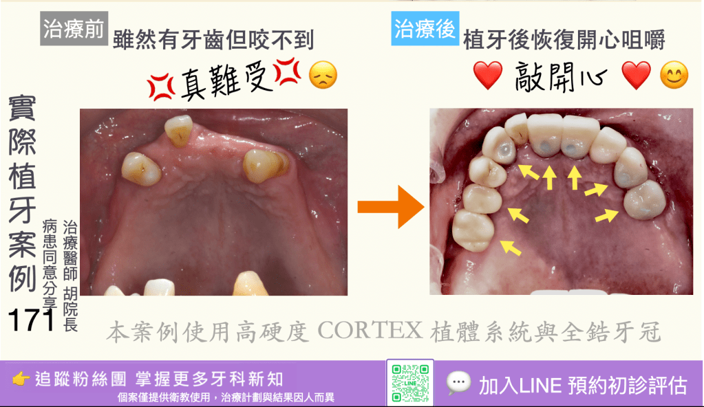 人工植牙治療實際案例成果169