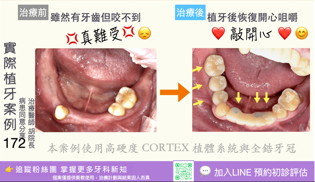 人工植牙治療實際案例成果170
