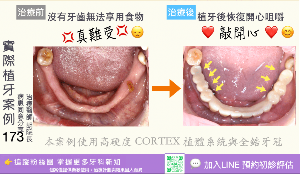 人工植牙治療實際案例成果171
